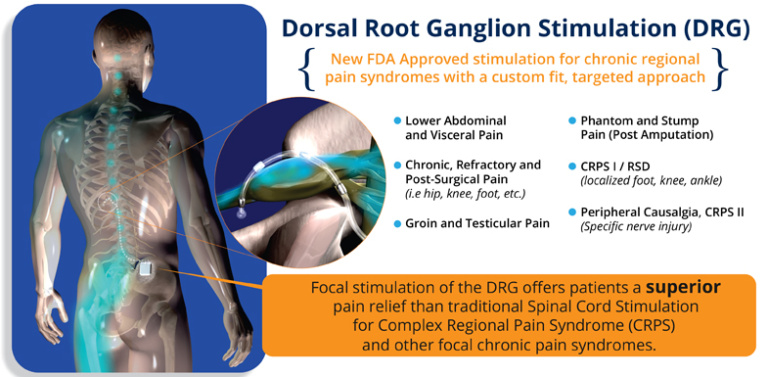 dorsal column stimulator cpt